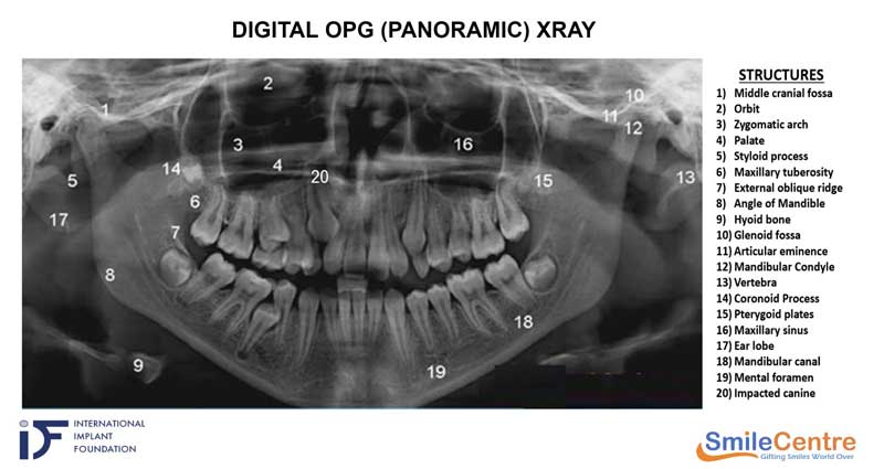 OPG X-Ray Panoramic radiograph - Diagnostic test