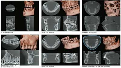 Dental cone beam-CT