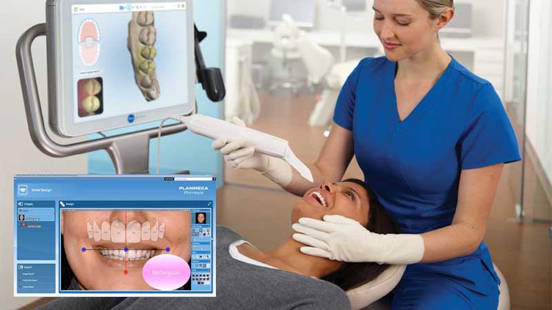 Digital smile design ( DSD)