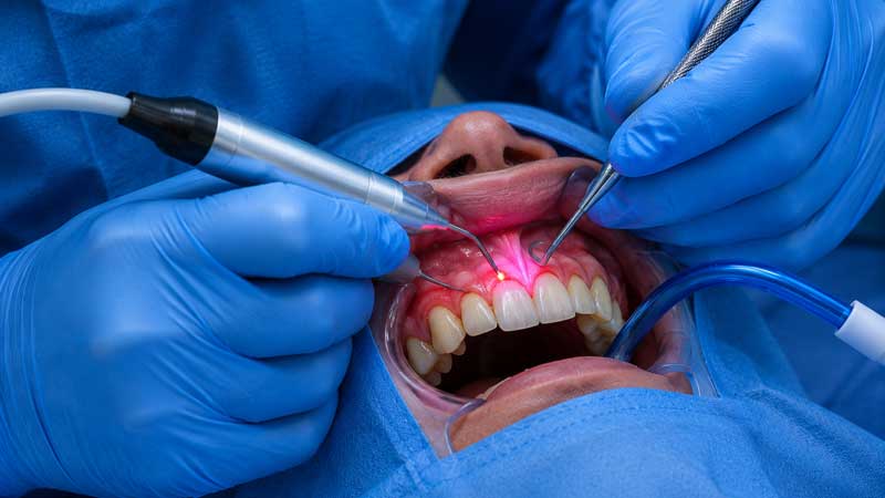 LANAP Surgery