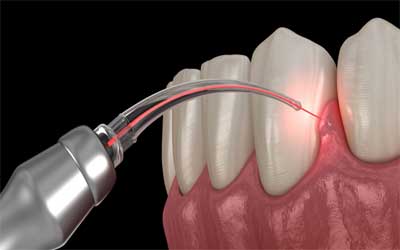 Soft tissue lasers for gum contouring