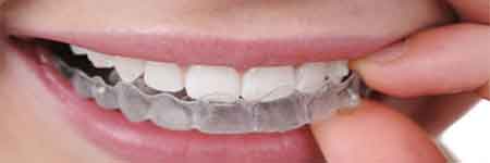 Clear Aligner Therapy