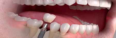 Dental Implants Services