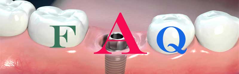 Frequently asked questions on Dental Crowns
