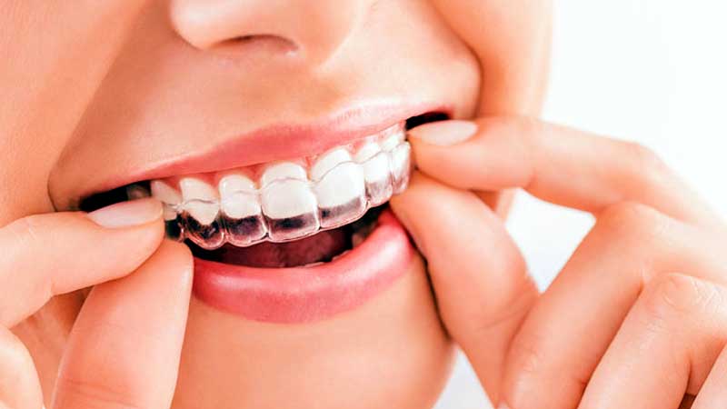 Clear Aligner Therapy