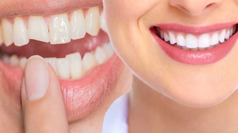 Tooth coloured Dental Filling & Dental Bonding