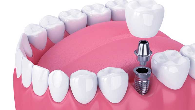 Dental Implant Cost