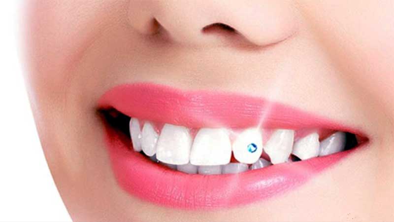 Dental jewelry, Tooth Gems