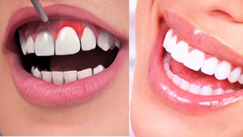 Gum contouring, Gummy Smile Correction