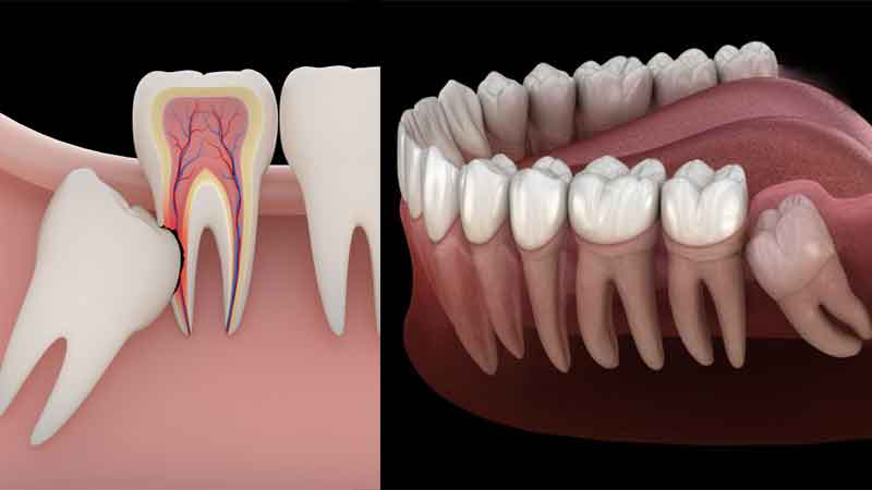 Impacted & Wisdom Teeth