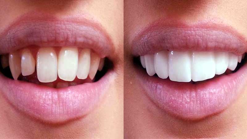 Natural Look Veneers