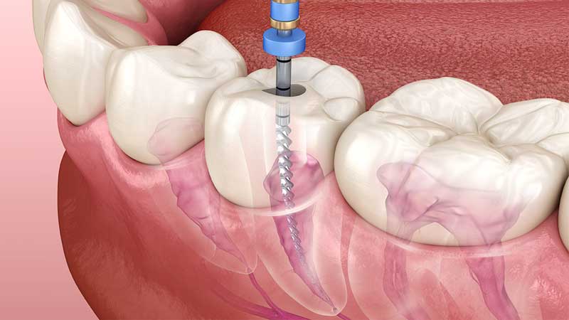 Root Canal Treatment Procedure