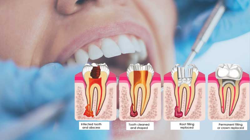 Root Canal Therapy