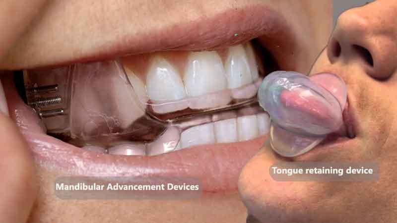 Treating Sleep Apnea With Dental Devices