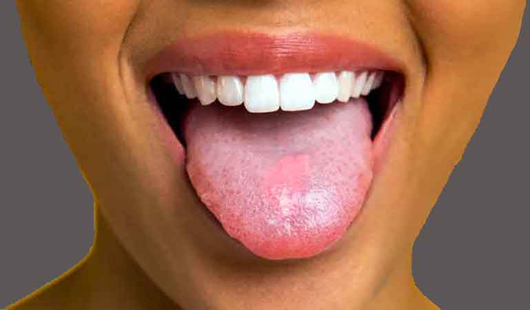 Tongue diseases