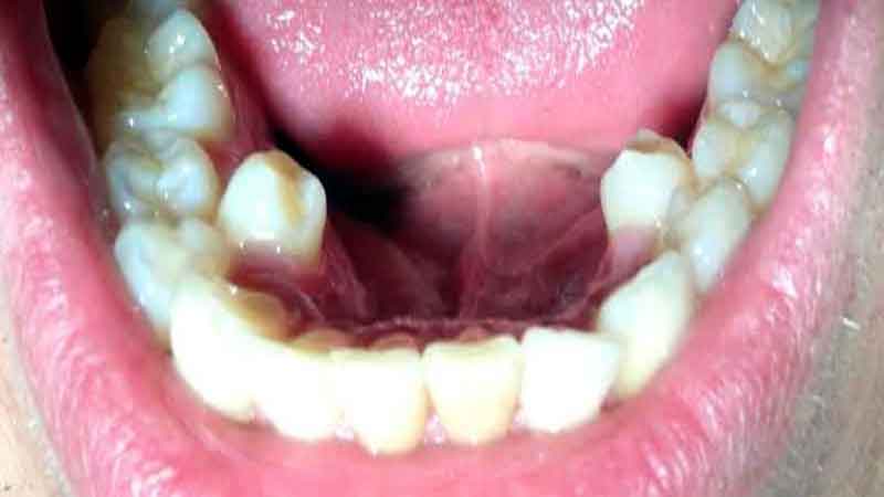 Hyperdontia